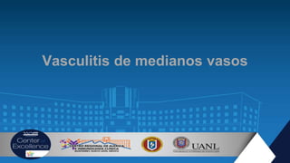 Vasculitis de medianos vasos
 