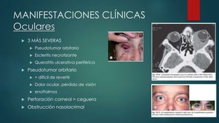  3 MÁS SEVERAS
 Pseudotumor orbitario
 Escleritis necrotizante
 Queratitis ulcerativa periférica
 Pseudotumor orbitario
 + difícil de revertir
 Dolor ocular, pérdida de visión
 enoftalmos
 Perforación corneal = ceguera
 Obstrucción nasolacrimal
MANIFESTACIONES CLÍNICAS
Oculares
 
