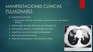 MANIFESTACIONES CLÍNICAS
PULMONARES
 Capilaritis pulmonar
 Hemorragia alveolar, hemoptisis y rápida aparición de infiltrado
alveolar
 Hemorragia alveolar difusa es una emergencia
 Adnopatías hiliares y mediastinales son raras
 Superficie mucosa bronquial empedrada
 Neumonía postobstructiva
 Afección bronquial es + frecuente en niños
 