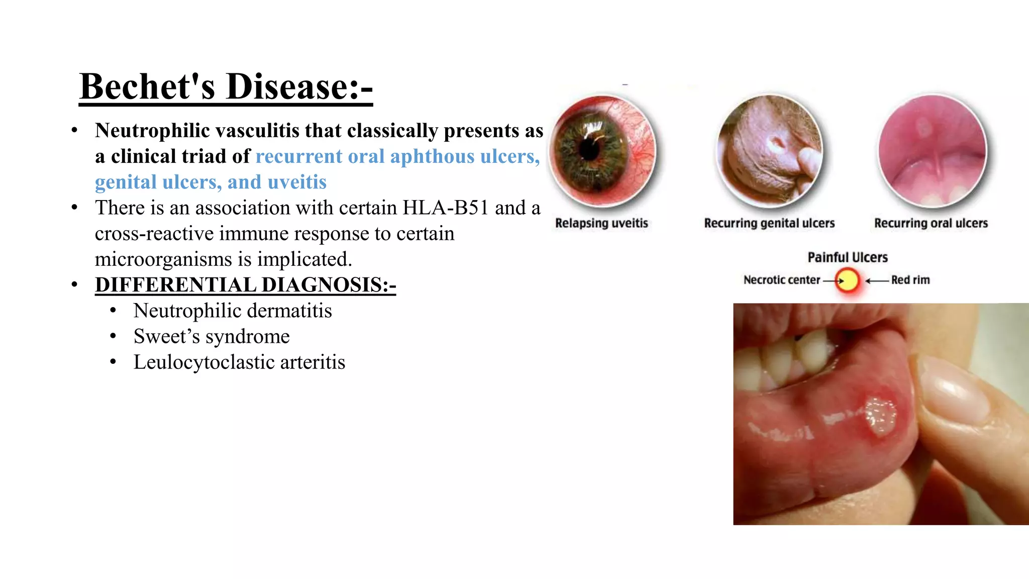 vasculitis-and-updates-pptx