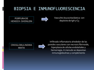 BIOPSIA E INMUNOFLUORESCENCIA
   PÚRPURA DE            Vasculitis leucocitoclástica con
HENOCH -SHONLEIN              depósito de IgA y C3




                     Infiltrado inflamatorio alrededor de las
CRIOGLOBULINEMIA   paredes vasculares con necrosis fibrinoide,
      MIXTA            hiperplasia de células endoteliales y
                      hemorragia. A menudo se depositan
                        inmunoglobulinas y complemento
 