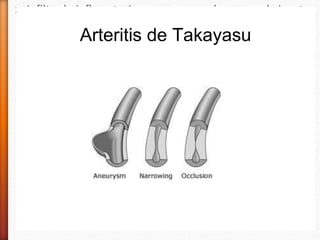 » Infiltrado inflamatorios por mononucleares y cel gigantes
» Fibrosis de la íntima, cicatrización
» Vascularización de la media
» Rotura y degeneración de la lamina elástica
» La luz se estrecha c/s trombosis
Arteritis de Takayasu
 
