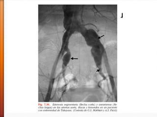 » Diagnóstico
˃ Arteriografía convencional : estenosis vasculares, circulación
colateral, aneurismas.
˃ Mujer joven con < de pusos arteriales o su desaparición
˃ Desigualdad de presión arterial
˃ Soplos
Arteritis de TakayasuArteritis de takayasu
 