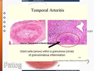 Patogenia:
 Infiltrado inflamatorio por mononucleares
 Acompañado de células gigantes
 Proliferación de la íntima
 Rotura de la lámina elástica interna
 Las manifestaciones se debe a la isquemia que ocasionan
los vasos afectados
 