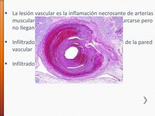  La lesión vascular es la inflamación necrosante de arterias
musculares, son segmentarias y tienden a bifurcarse pero
no llegan hasta las vénulas
 Infiltrado neutrófilo y PMN en todas las capas de la pared
vascular
 Infiltrado mononuclear en cronicidad
 