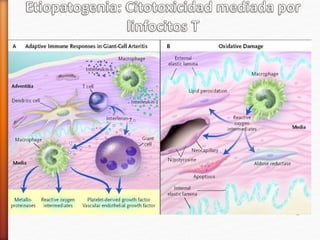 Se caracteriza por presencia de inflamación granulomatosa y de
célualas gigantes
Mediada por:
Linfocitos T CD4+
Linfocitos CD8+ citotóxicos
Macrófagos activados
Células dendríticas
Células NK
Estos factores se adhieren debido a una proliferación clonal hacía un
Ag producido en la pared vascular o por estimulación de un Ag
 