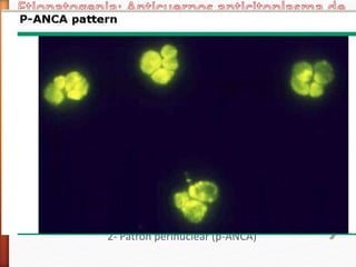 Desde 1982 se han detectado en las vasculitis presencia de auto-Acs
VS proteínas del citoplasma de los neutrófilos: ANCA enzimas (
c-ANCA)contra proteinasa-3 (PR3) EN 80 % de Px
(p-ANCA) contra mieloperoxidasa (MPO)
Principalmente en vasculitis necrotizantes de vasos de pequeño y
mediano calibre
Mediante inmunofluorescencia producen dos tipos de patrones:
1- Patrón citoplasmático (c-ANCA)
2- Patrón perinuclear (p-ANCA)
 