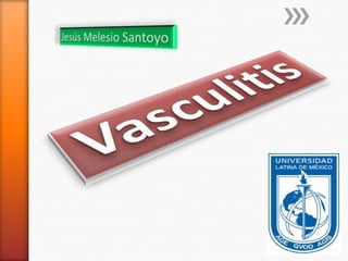 Jesús Melesio Santoyo,[object Object],Vasculitis,[object Object]