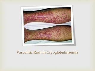 Vasculitic Rash in Cryoglobulinaemia
 