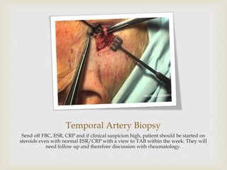 Temporal Artery Biopsy
Send off FBC, ESR, CRP and if clinical suspicion high, patient should be started on
steroids even with normal ESR/CRP with a view to TAB within the week. They will
need follow up and therefore discussion with rheumatology.
 