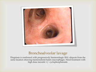 Bronchoalveolar lavage
Diagnosis is confirmed with progressively haemorrhagic BAL aliquots from the
same location showing haemosiderin-laden macrophages. Need treatment with
high dose steroids +/- cyclophosphamide.
 