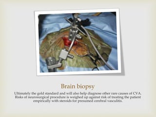 Brain biopsy
Ultimately the gold standard and will also help diagnose other rare causes of CVA.
Risks of neurosurgical procedure is weighed up against risk of treating the patient
empirically with steroids for presumed cerebral vasculitis.
 