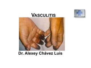VASCULITIS
Dr. Alexey Chávez Luis
 