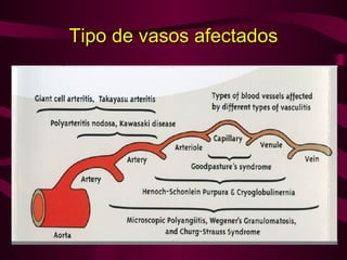 Tipo de vasos afectados
 