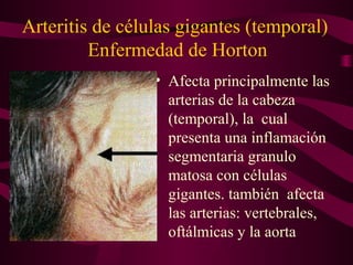 Arteritis de células gigantes (temporal)
         Enfermedad de Horton
                 • Afecta principalmente las
                   arterias de la cabeza
                   (temporal), la cual
                   presenta una inflamación
                   segmentaria granulo
                   matosa con células
                   gigantes. también afecta
                   las arterias: vertebrales,
                   oftálmicas y la aorta
 