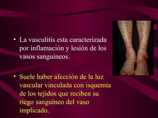 • La vasculitis esta caracterizada
  por inflamación y lesión de los
  vasos sanguíneos.

• Suele haber afección de la luz
  vascular vinculada con isquemia
  de los tejidos que reciben su
  riego sanguíneo del vaso
  implicado.
 