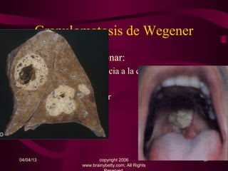 Granulomatosis de Wegener
• Compromiso pulmonar:
     – Nódulos con tendencia a la cavitación.

     – Hemorragia alveolar

     – Derrame pleural



04/04/13                  copyright 2006             37
                   www.brainybetty.com; All Rights
 