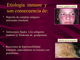 Etiología inmune y                        arteritis aguda en eLES

   son consecuencia de:
• Deposito de complejo antígeno-
  anticuerpo circulante



• Anticuerpos fijados a los antígenos
  tisulares ej: Síndrome de goodpasture
                                              arteritis de la temporal


• Reacciones de hipersensibilidad
  retardada, especialmente en lesiones con
  granulomas
 