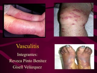 Vasculitis
   Integrantes:
Reveca Pinto Benítez
 Gisell Velázquez
 