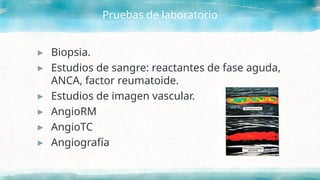Pruebas de laboratorio
▸ Biopsia.
▸ Estudios de sangre: reactantes de fase aguda,
ANCA, factor reumatoide.
▸ Estudios de imagen vascular.
▸ AngioRM
▸ AngioTC
▸ Angiografía
 