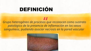 “
Grupo heterogéneo de procesos que reconocen como sustrato
patológico de la presencia de inflamación en los vasos
sanguíneos, pudiendo asociar necrosis en la pared vascular
2
DEFINICIÓN
 