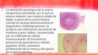 ▸ La afectación patológica de la arteria
temporal es parcheada, por lo que es
preciso obtener una muestra amplia de
tejido, a pesar de lo cual la biopsia
normal no excluye definitivamente el
diagnóstico. Histológicamente, se
produce una inflamación de arterias de
mediano y gran calibre, caracterizada
por un infiltrado de células
mononucleares. Es frecuente la
presencia de granulomas y células
gigantes. Existe, asimismo,
proliferación de la íntima y disrupción
de la lámina elástica.
 