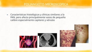 POLIANGEITIS MICROSCOPICA
▸ Características histológicas y clínicas similares a la
PAN, pero afecta principalmente vasos de pequeño
calibre especialmente capilares y vénulas
 
