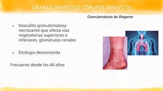 GRANULOMATOSIS CON POLIANGEITIS
▸ Vasculitis granulomatosa
necrozante que afecta vías
respiratorias superiores e
inferiores, glomérulos renales
▸ Etiologia desconocida
Frecuente desde los 40 años
Granulomatosis de Wegener
 