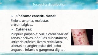 Sospecha diagnostica
▸ Síndrome constitucional:
Fiebre, astenia, malestar,
artromialgias..
▸ Cutáneas:
Purpura palpable: Suele comenzar en
zonas declives, nódulos subcutáneos,
urticaria crónica, livero reticularis,
ulceras, telangiectasias del lecho
ungueal, infarto o gangrena digital.
 