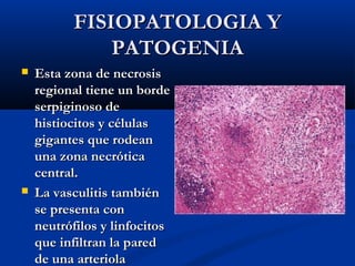 FISIOPATOLOGIA YFISIOPATOLOGIA Y
PATOGENIAPATOGENIA
 Esta zona de necrosisEsta zona de necrosis
regional tiene un borderegional tiene un borde
serpiginoso deserpiginoso de
histiocitos y célulashistiocitos y células
gigantes que rodeangigantes que rodean
una zona necróticauna zona necrótica
central.central.
 La vasculitis tambiénLa vasculitis también
se presenta conse presenta con
neutrófilos y linfocitosneutrófilos y linfocitos
que infiltran la paredque infiltran la pared
de una arteriolade una arteriola
 