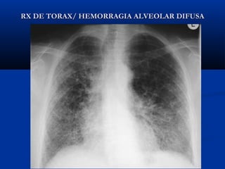 RX DE TORAX/ HEMORRAGIA ALVEOLAR DIFUSARX DE TORAX/ HEMORRAGIA ALVEOLAR DIFUSA
 