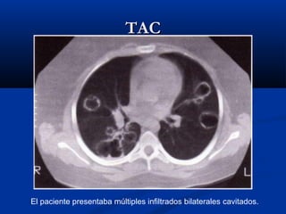 TACTAC
El paciente presentaba múltiples infiltrados bilaterales cavitados.
 