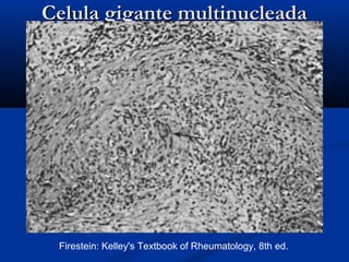 Celula gigante multinucleadaCelula gigante multinucleada
Firestein: Kelley's Textbook of Rheumatology, 8th ed.
 