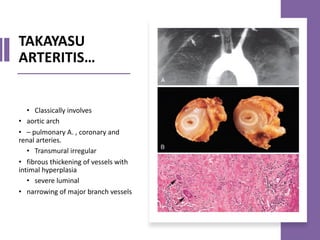 TAKAYASU
ARTERITIS…
• Classically involves
• aortic arch
• – pulmonary A. , coronary and
renal arteries.
• Transmural irregular
• fibrous thickening of vessels with
intimal hyperplasia
• severe luminal
• narrowing of major branch vessels
 