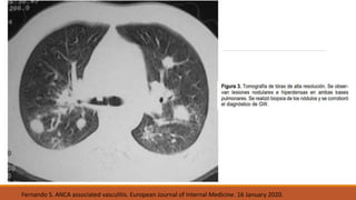 Fernando S. ANCA associated vasculitis. European Journal of Internal Medicine. 16 January 2020.
 