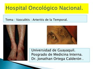 Tema : Vasculitis : Arteritis de la Temporal.
Universidad de Guayaquil.
Posgrado de Medicina Interna.
Dr. Jonathan Ortega Calderón .
 
