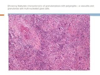 Showing features characteristic of granulomatosis with polyangiitis - a vasculitis and
granulomas with multi-nucleated giant cells.
-
 