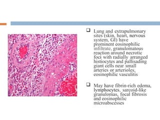 -  Lung and extrapulmonary
sites (skin, heart, nervous
system, GI) have
prominent eosinophilic
infiltrate, granulomatous
reaction around necrotic
foci with radially arranged
histiocytes and pallisading
giant cells near small
arteries or arterioles,
eosinophilic vasculitis
 May have fibrin-rich edema,
lymphocytes, sarcoid-like
granulomas, focal fibrosis
and eosinophilic
microabscesses
 