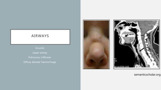 AIRWAYS
Sinusitis
Upper airway
Pulmonary infiltrates
Diffuse alveolar haemorrhage
semanticscholar.org
 