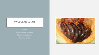 VASCULAR EVENT
Stroke
Retinal vascular occlusion
Mesenteric infarction
Mononeuropathy
 