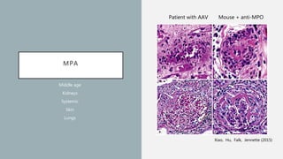MPA
Middle age
Kidneys
Systemic
Skin
Lungs
Patient with AAV Mouse + anti-MPO
Xiao, Hu, Falk, Jennette (2015)
 