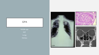 GPA
Middle age
ENT
Lungs
Kidneys
 