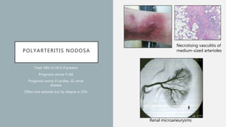 POLYARTERITIS NODOSA
Treat HBV or HCV if present
Prognosis worse if old
Prognosis worse if cardiac, GI, renal
disease
Often one episode but 5y relapse is 25%
Necrotising vasculitis of
medium-sized arterioles
Renal microaneurysms
 