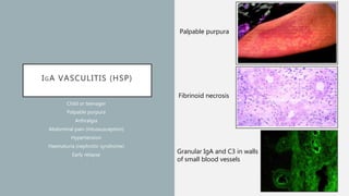 IGA VASCULITIS (HSP)
Child or teenager
Palpable purpura
Arthralgia
Abdominal pain (intussusception)
Hypertension
Haematuria (nephrotic syndrome)
Early relapse
Granular IgA and C3 in walls
of small blood vessels
Fibrinoid necrosis
Palpable purpura
 