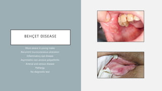 BEHÇET DISEASE
More severe in young males
Recurrent mucocutaneous ulceration
Inflammatory eye disease
Asymmetric non-erosive polyarthritis
Arterial and venous disease
Pathergy
No diagnostic test
 