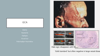 GCA
Elderly
Headache
Diplopia
Visual loss
Polymyalgia rheumatica
Halo sign: disappears with Rx
‘Gold standard’ but often negative in large vessel disea
 