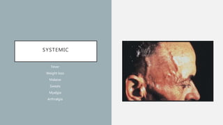 SYSTEMIC
Fever
Weight loss
Malaise
Sweats
Myalgia
Arthralgia
 