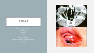 OCULAR
Orbital pseudo-tumour
Episcleritis
Scleritis
Uveitis
Retinal vasculitis
Anterior ischaemic optic neuropathy
Diplopia
 