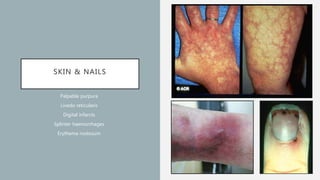 SKIN & NAILS
Palpable purpura
Livedo reticularis
Digital infarcts
Splinter haemorrhages
Erythema nodosum
 