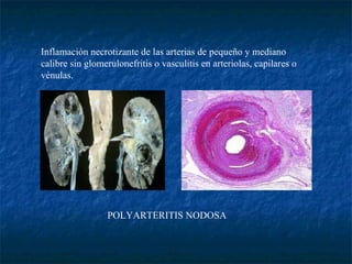 Inflamación necrotizante de las arterias de pequeño y mediano calibre sin glomerulonefritis o vasculitis en arteriolas, capilares o vénulas. POLYARTERITIS NODOSA                                                                                               